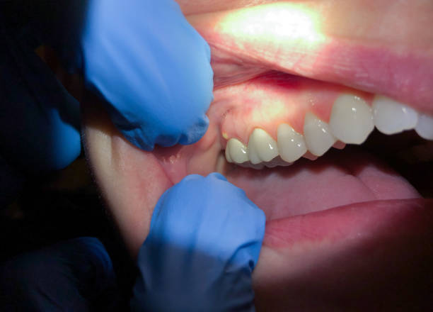 Best Emergency Care for Gum Disease in Edcouch, TX